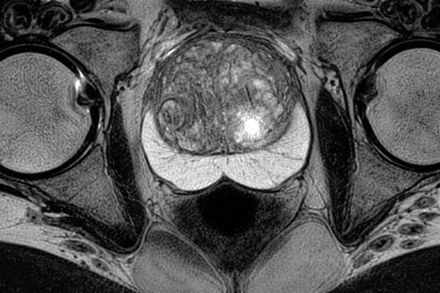 MRI for Prostate Cancer