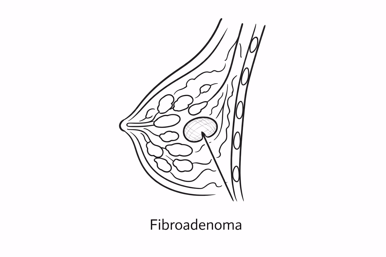 Fibroadenoma Breast