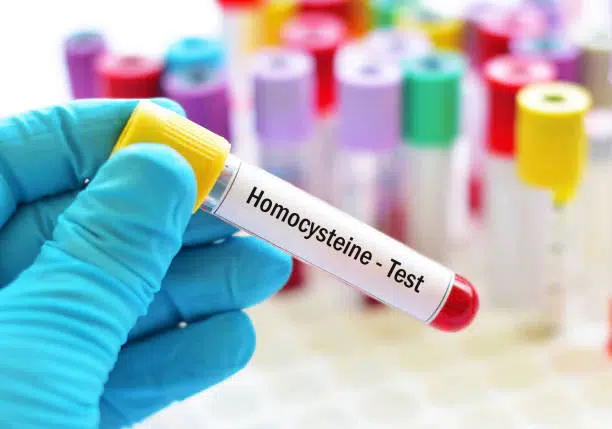 Homocysteine Test