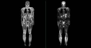 Whole Body DWI MRI