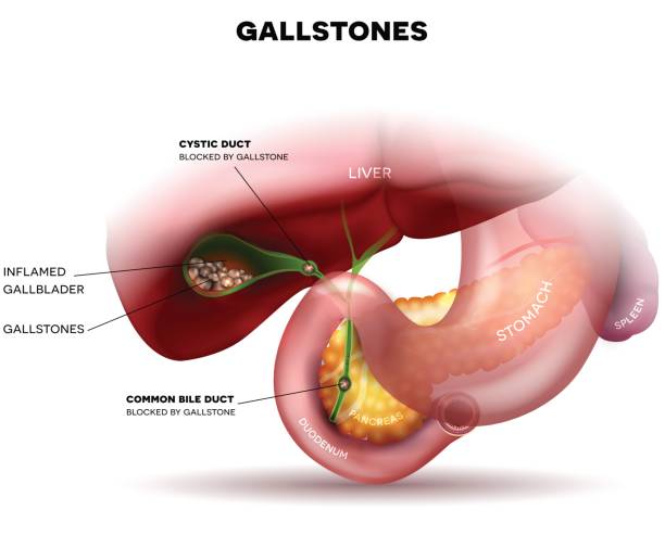 gallstone