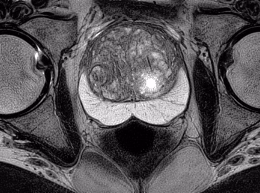 MRI for Prostate Cancer