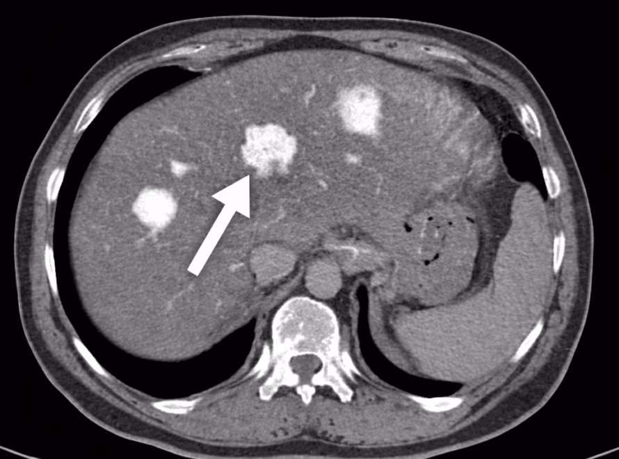 CT Scan for Liver Lesions