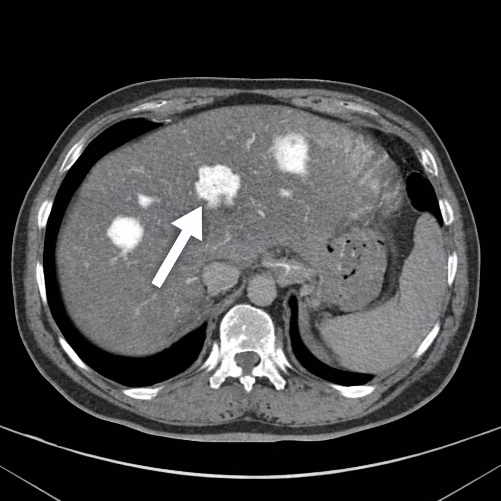 CT Scan for Liver Lesions