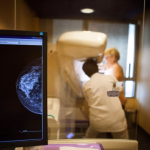 Unilateral USG  Breast and Mammogram